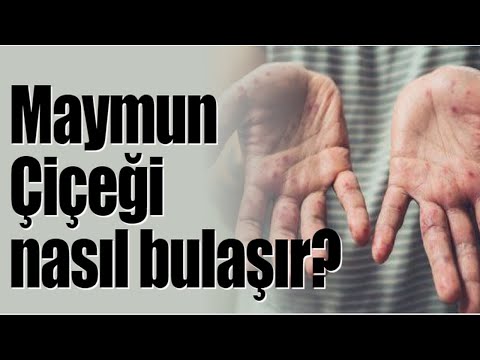 Maymun çiçeği virüs alarmı |  Prof. Dr. İsmail Balık aktardı