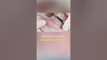 Toàn cảnh quá trình gắn mắc cài chỉnh nha | Dr Điêu Tài Thu #shorts #chinhnha #niengrang