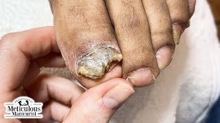 👣Tips to Treat Nail Fungus at Home👣