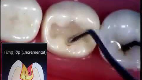 kỹ thuật trám răng với composite(B.D)