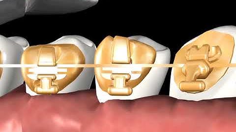 Incognito™ Appliance System Clinical Guide 02: Normal Elastic Tie