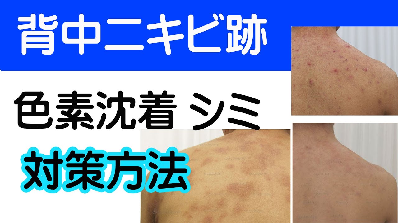 背中ニキビ跡のシミを消す方法 ニキビ 赤ら顔専門 こことみ Youtube 背中ニキビ跡のシミを消す方法 ニキビ 赤ら顔専門 こことみ Youtube
