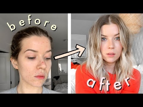 how I cover my acne // *skin picking edition*