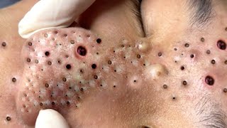 Relax Every Day With Treatment Satisfying blackhead relaxing acne, pimple, cyst by FISHING VIDEO 118 views 1 year ago 5 minutes, 17 seconds