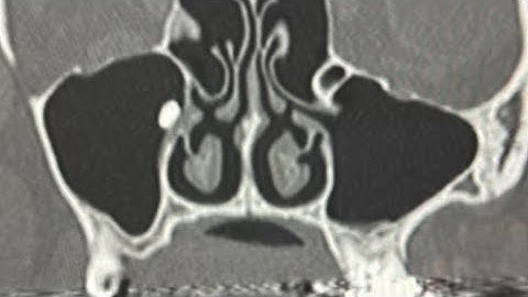 Caldwell-Luc approach to retrieve tooth root in maxillary sinus