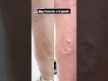 РЕЗУЛЬТАТ сразу после лазера🔆🔆🔆