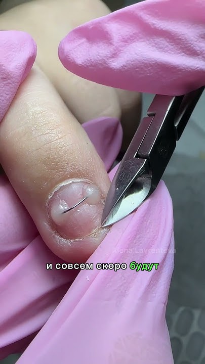 Как восстановить ноготь на руке? Установка титановой нити на ноготь ...
