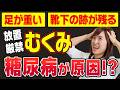 【足がパンパン】そのむくみ、糖尿病かもしれません！
