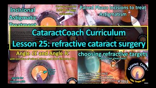 CataractCoach™ 1861: curriculum lesson 25: refractive cataract surgery