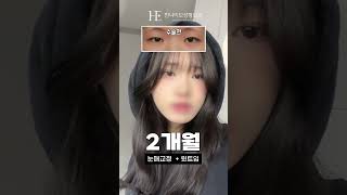 눈매교정 + 윗트임 2개월 후기