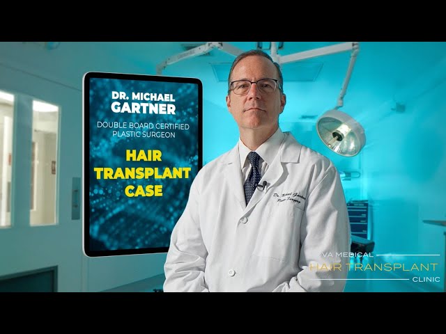 Dr. Gartner Patient Case: 3300 Graft FUE Procedure | Nova Medical Hair Transplant Clinic