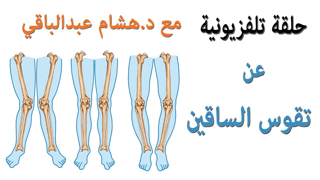 تقوس الساقين فى الأطفال و الكبار - الأسباب والعلاج