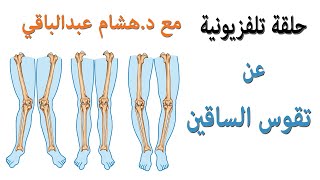 تقوس الساقين فى الأطفال و الكبار - الأسباب والعلاج