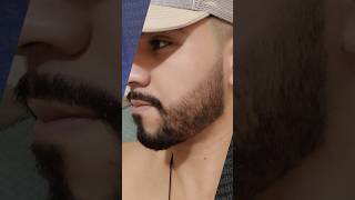 1 Ano E 3 Meses De Tratamento Com Minoxidil Evolução Minoxidil