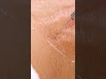 Up Close View Of How Laser Stretch Mark Removal Works Shorts