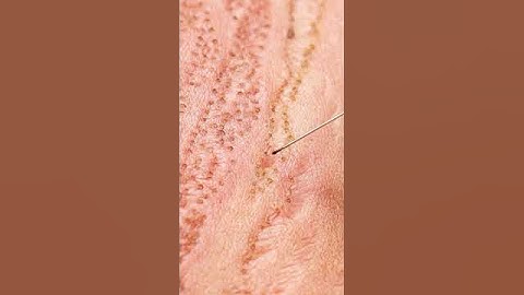 Up close view of how laser stretch mark removal works! 😯 #shorts