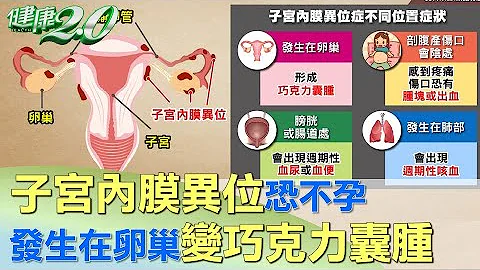 位置有差异！ 子宫内膜异位发生卵巢变巧克力囊肿 健康2.0 - 天天要闻