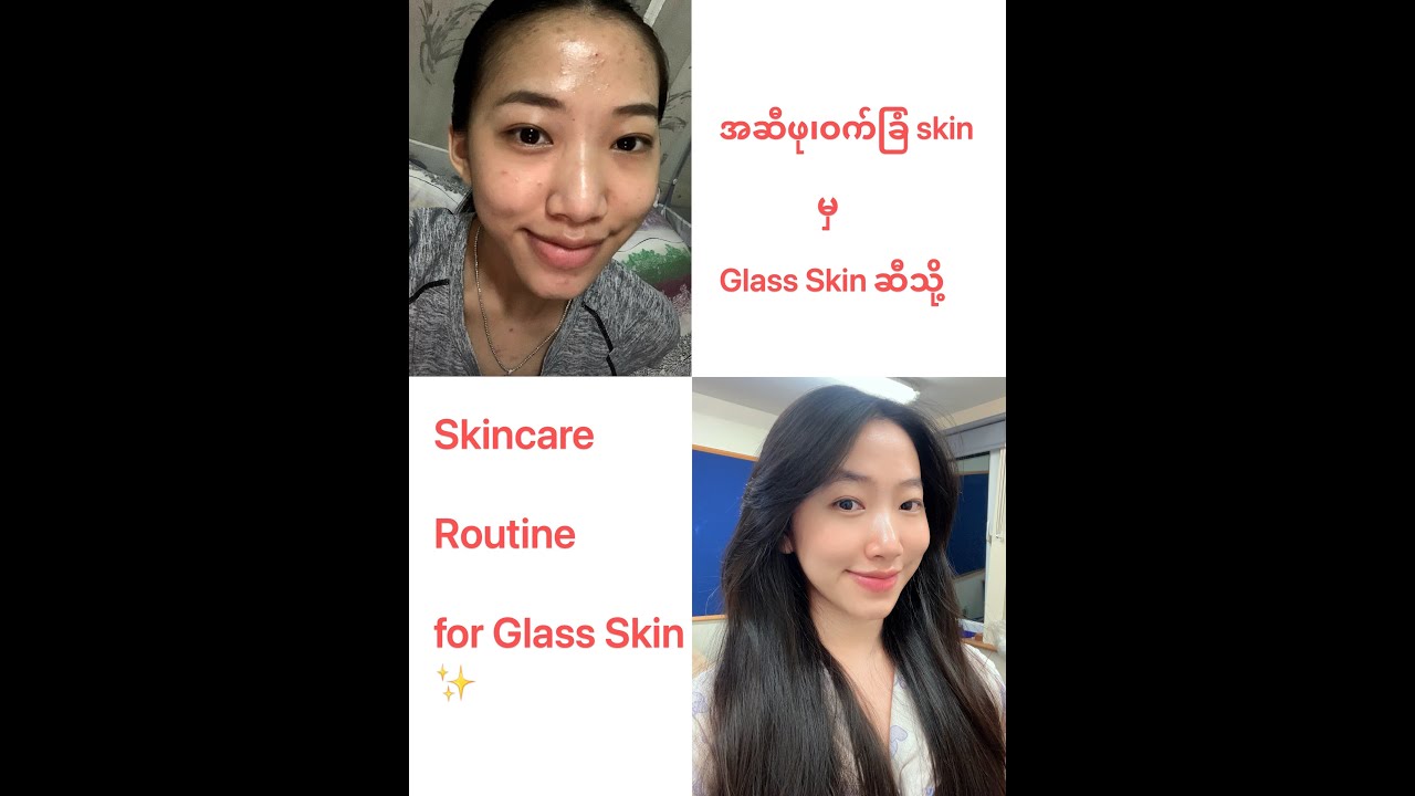 အဆီဖု၊ဝက်ခြံသမားတွေအတွက် skincare routine ✨