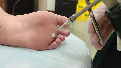 病毒疣冷冻治疗 https://drchenskin.family.blog/ - 天天要闻