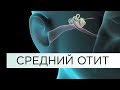 СРЕДНИЙ ОТИТ