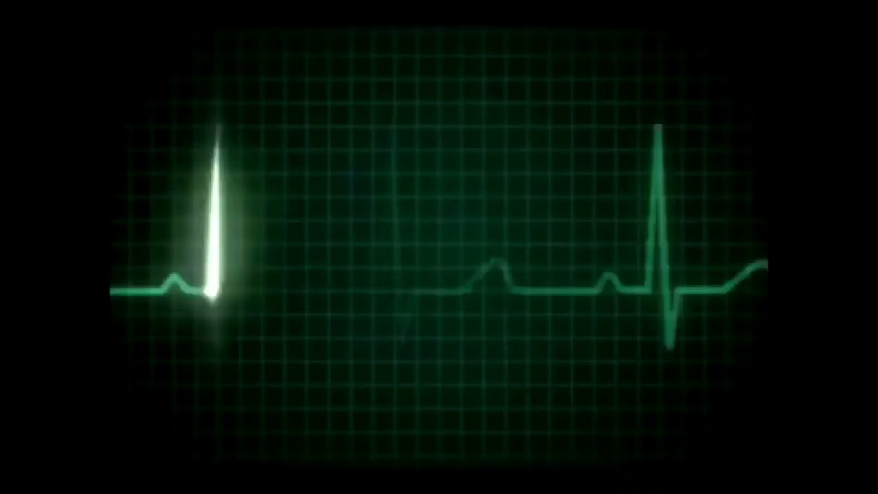 Пульс остановился. Кардиограмма остановки сердца. Кардилграммаостановка сердца. Остановка сердца на ЭКГ. Кардиограмма gif.