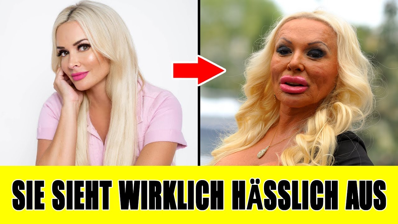 13 schöne deutsche Stars mit schockierend entstellten Gesichtern durch Schönheitsoperationen