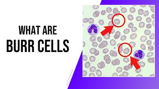 Burr Cells Explained | Don’t Miss This Hematology Clue! 🔬🩸