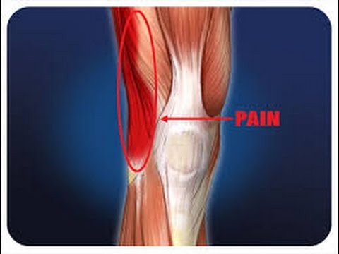 left it band syndrome and knee how to fix it in muscles of the knee