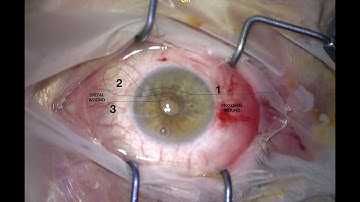 Modified Siepser Knot for iris defect repair (pupilloplasty).
