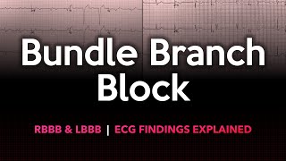 Left and Right Bundle Branch Block: ECG Made Easy