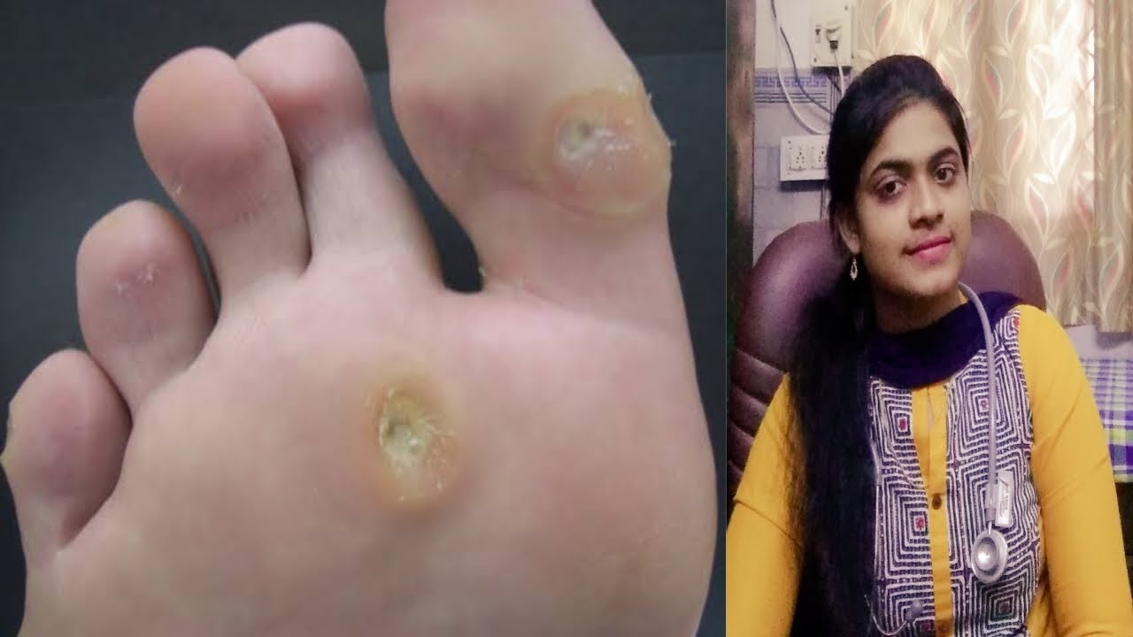 கால் ஆணி Corn foot treatment without surgery Tamil Dr. Joyselin