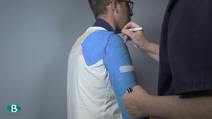 Sarmiento Brace  Humeral Fracture Splint and Upper Arm Support