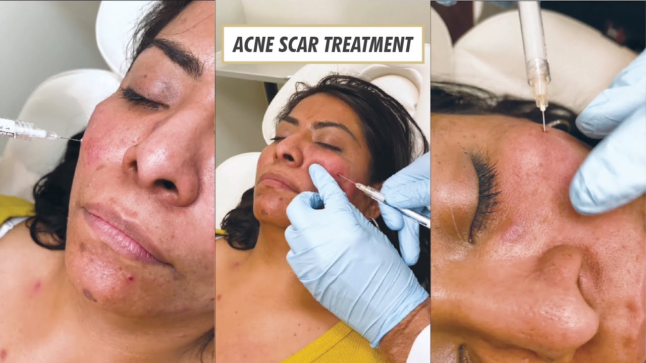 ACNE SCAR TREATMENT USING SUBCISION AND BELLAFILL YouTube