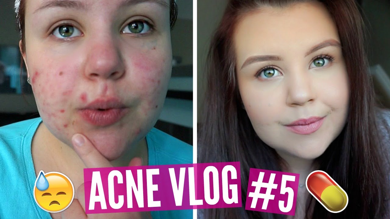 MY SKIN ISN'T DRY! 2 MONTHS ON ACCUTANE | Acne Vlog - YouTube