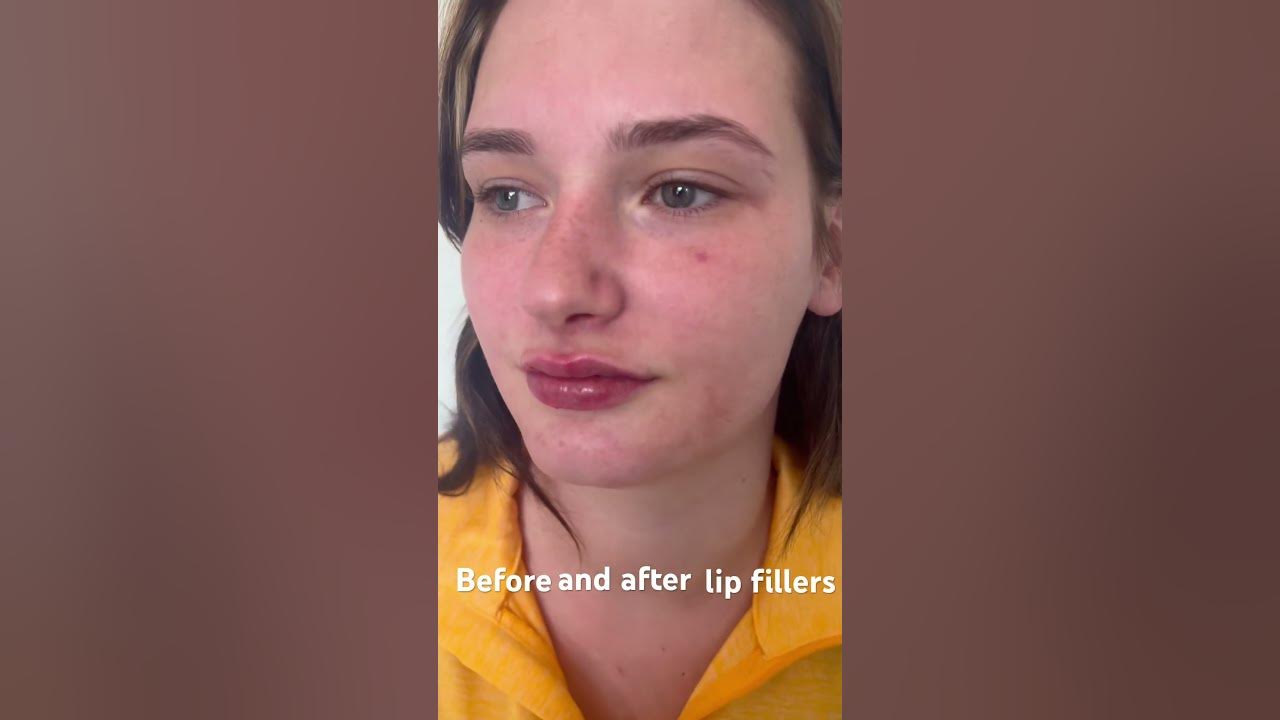 before-after-lip-fillers-lipfillers-lipinjections-filler-russian
