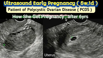 Polycystic Ovaries ( PCOS ) - How she Got Pregnancy ?? | TVS Ultrasound