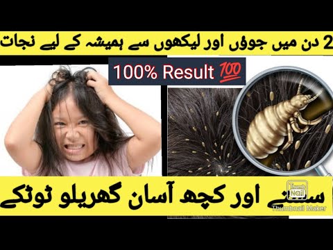 Juon or Likhon se Nijat  Anti Lice Treatment at Home  How to Get Rid of Head Lice Only 10mintues