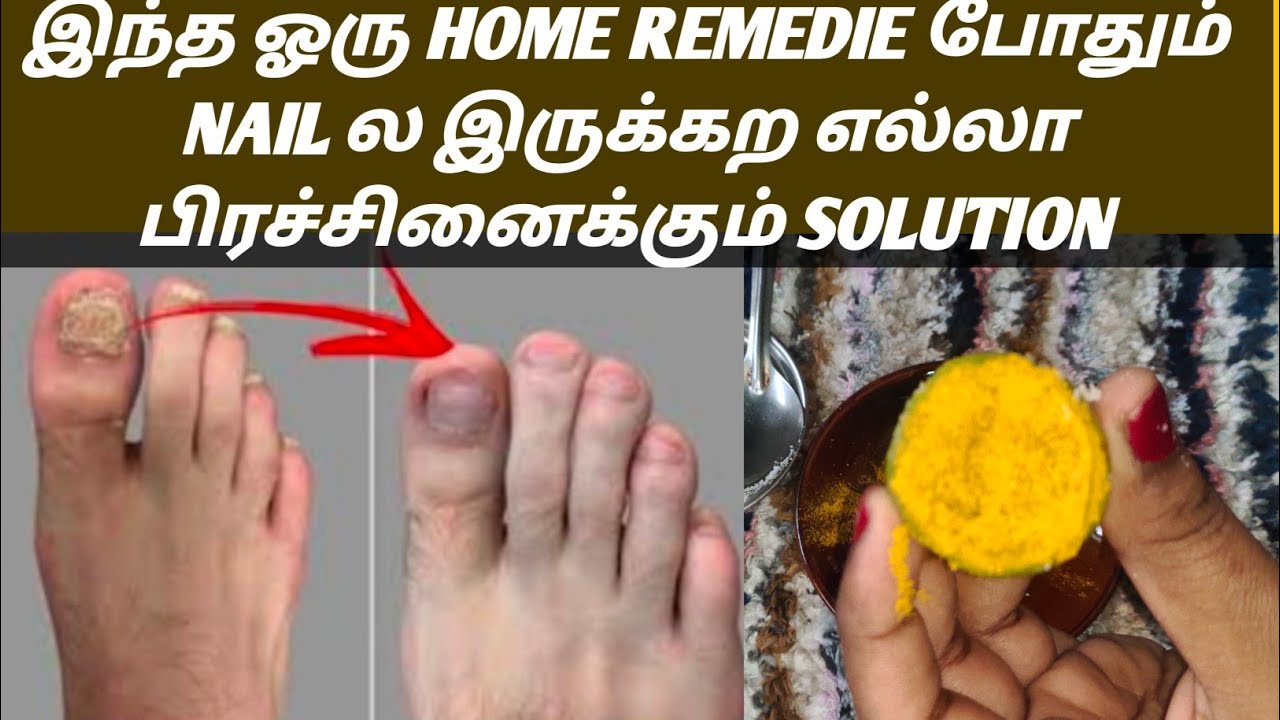 Natural Ayurvedic Home Remedies for Toenail Fungus In Tamil