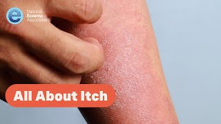All About Itch