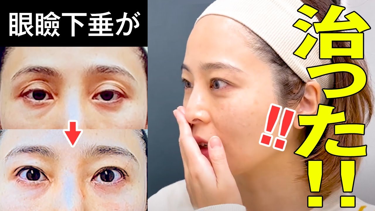 【眼瞼下垂　埋没法】眼瞼下垂と上まぶたのくぼみが、同時に治った！