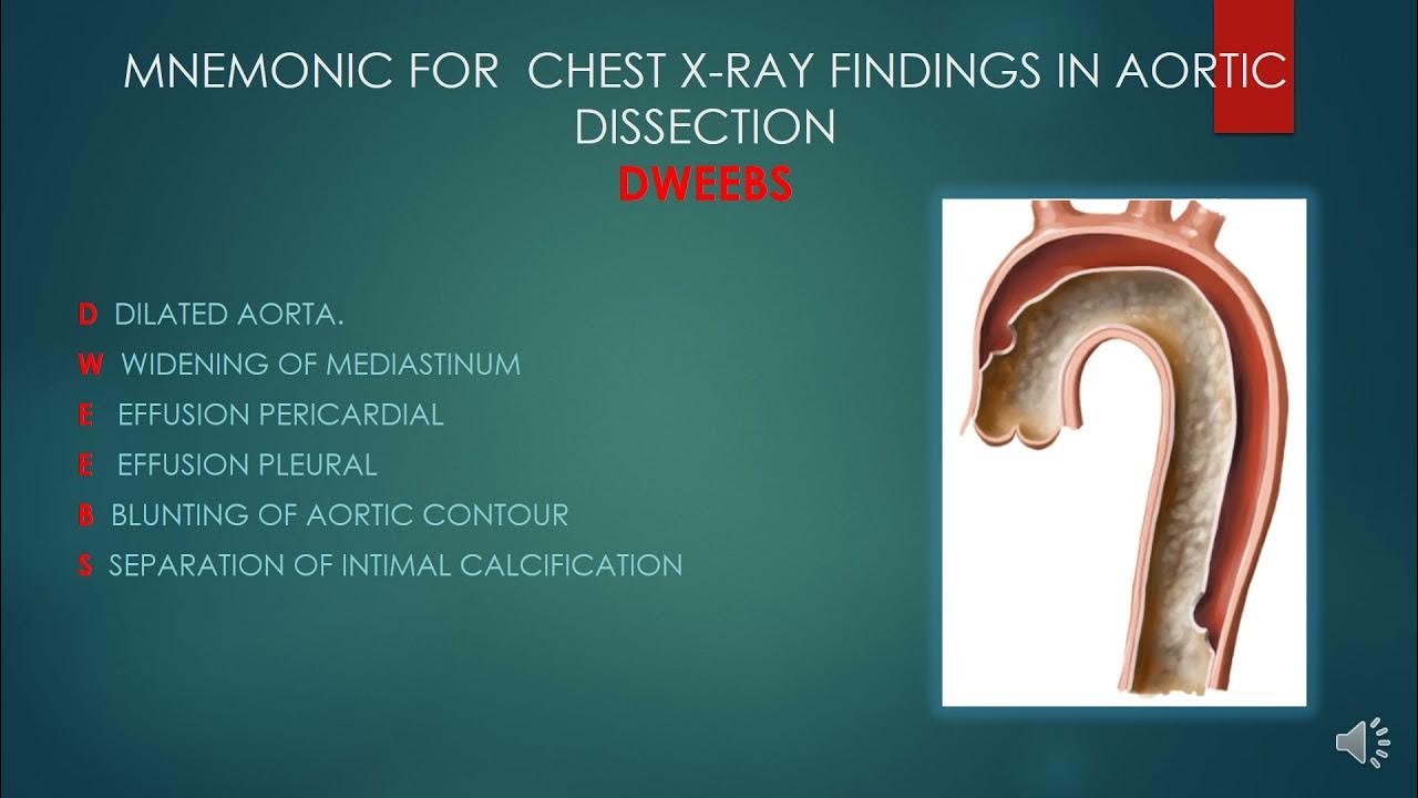 MNEMONIC FOR CHEST XRAY FINDINGS IN AORTIC DISSECTION DWEEBS YouTube