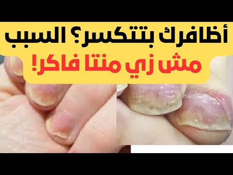 صدفية الأظافر أم فطريات الفرق الخطير اللي لازم تعرفه