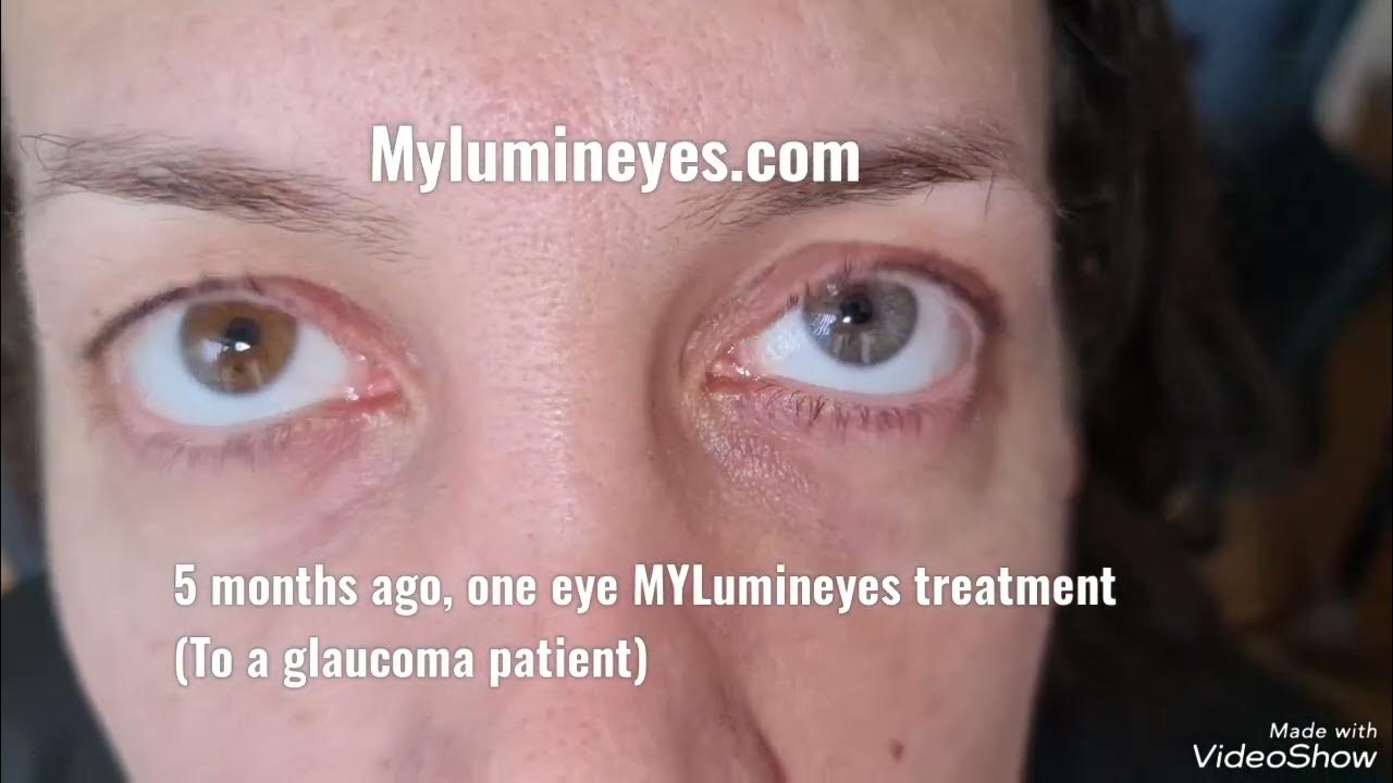 Laser Eye Color Change Surgery (Lumineyes) on a patient