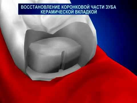 Восстановление коронковой части зуба