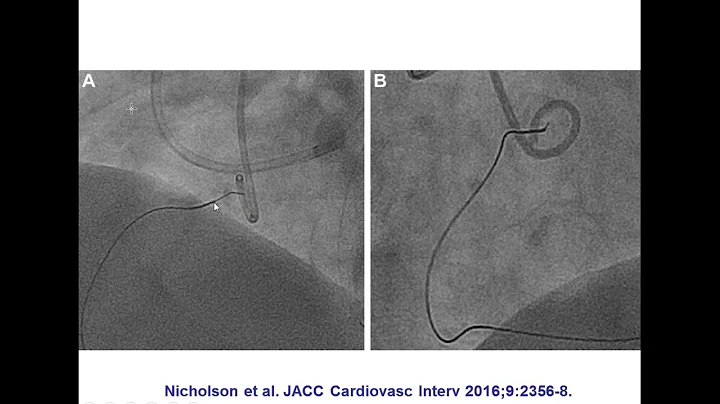 Emmanouil Brilakis - CTO Percutaneous Coronary Intervention Update 2017 - 2/06/2017