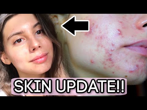 skin-update-||-how-is-my-skin-doing,-what-am-i-taking,-what-actually-worked??!