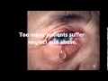 Indiana Nursing Home Lawyer for Neglect and Abuse