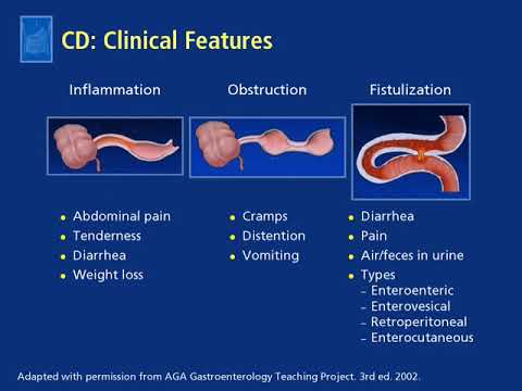 Video: Kemoterapi Til Crohns: Methotrexat, 6-MP Og Infliximab