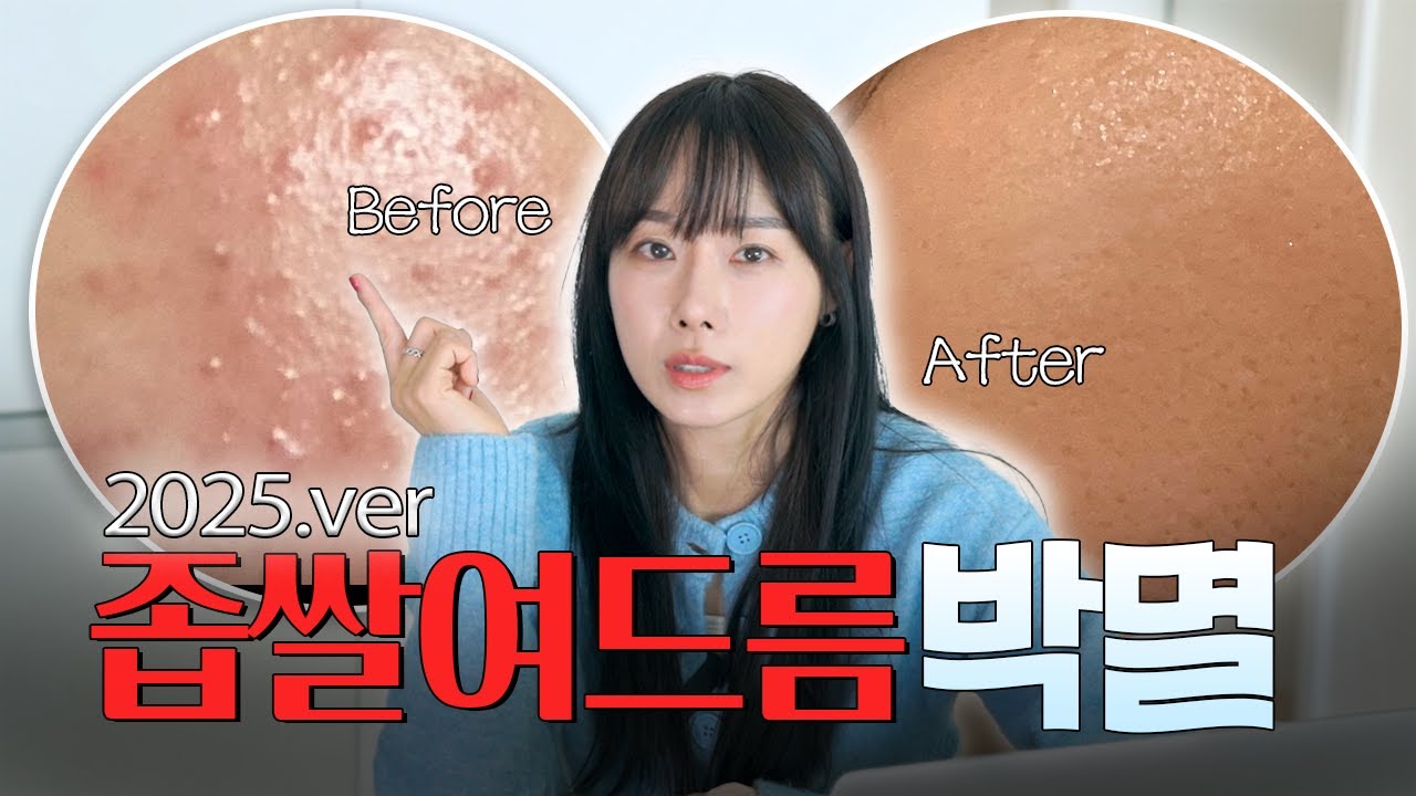이제 진짜 없애보자ㅠㅠ 좁쌀여드름 없애는 꿀팁! 🎯 100% 효과보장 비법 대공개 🔥 (최신 ver.) 광고X