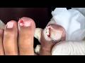 Wow, Super Thick Onychomycosis Requires Careful Trimming! #toenails  #13